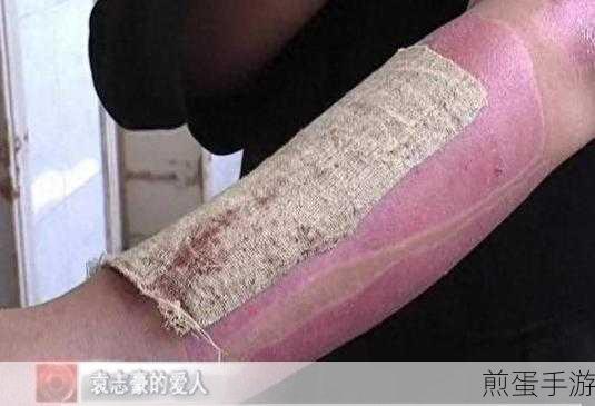 全网公敌,揭秘左臂烧伤背后的真相探索